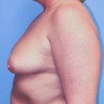 Breast Augmentation Before Patient Thumbnail 3