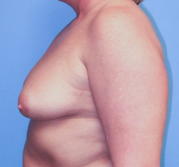 Breast Augmentation Before Patient 3