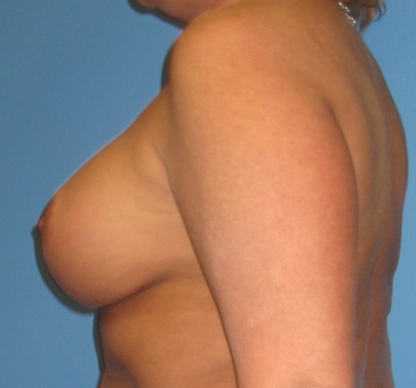 Breast Augmentation After Patient 3