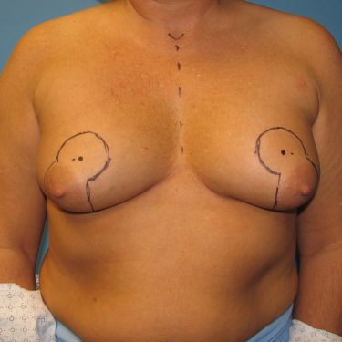 Breast Lift Before Patient 24