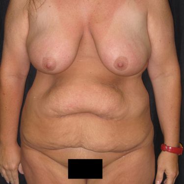 Surgery After Weight Loss Before Patient 10