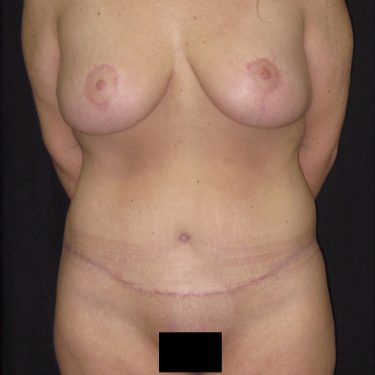 Surgery After Weight Loss After Patient 10