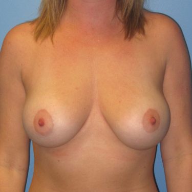 Subglandular After Patient 25