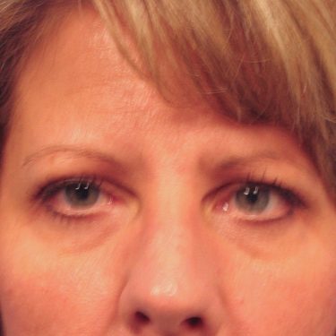 Eyes & Brow Before Patient 11