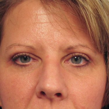 Eyes & Brow After Patient 11