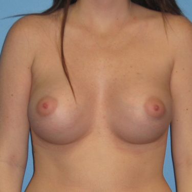 Breast Augmentation After Patient 17