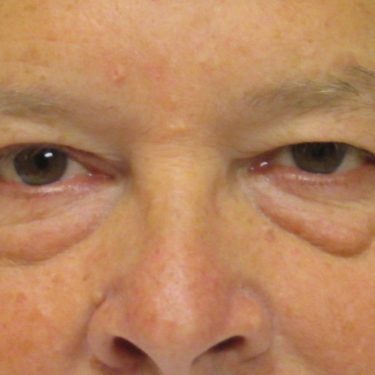 Eyes & Brow Before Patient 15