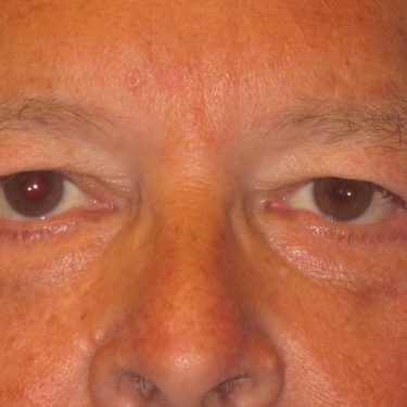 Eyes & Brow After Patient 15