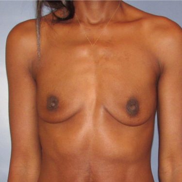 Breast Augmentation Before Patient 14