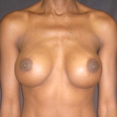Breast Augmentation After Patient 14