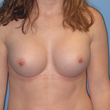 Breast Augmentation After Patient 12