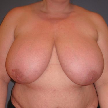 Breast Reduction Before Patient 1