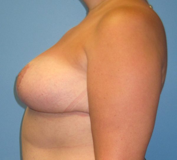Breast Reduction After Patient 3