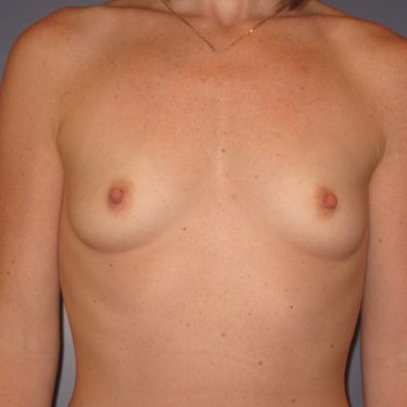 Breast Augmentation Before Patient 9