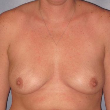 Subglandular Before Patient 22