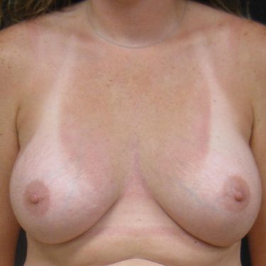 Subglandular After Patient 22