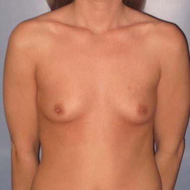 Breast Augmentation Before Patient 7