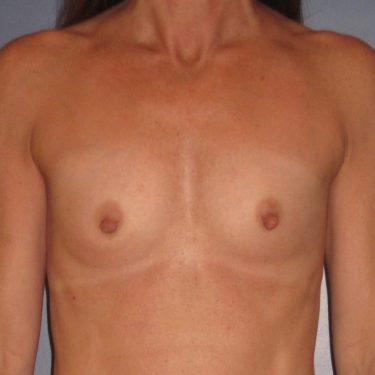 Breast Augmentation Before Patient 6