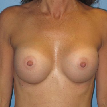 Breast Augmentation After Patient 6