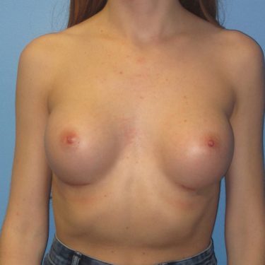 Breast Augmentation After Patient 5