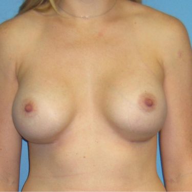 Dual-plane technique After Patient 8