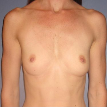 Breast Augmentation Before Patient 3