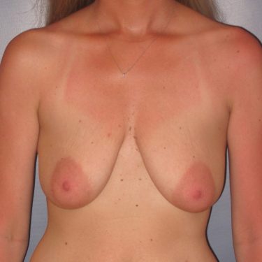 Breast Lift Before Patient 9