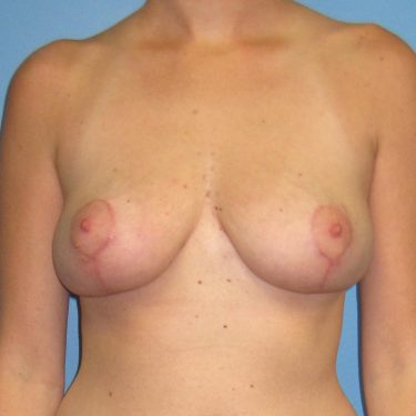 Breast Lift After Patient 9