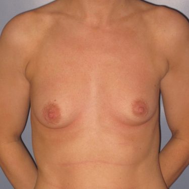 Dual-plane technique Before Patient 7