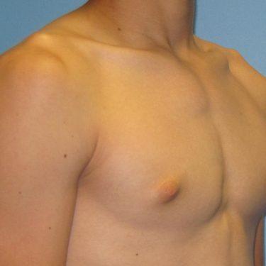 Gynecomastia Surgery Before Patient 3