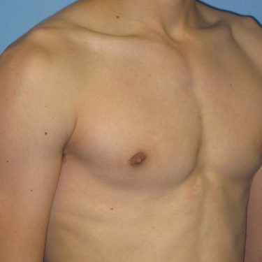 Gynecomastia Surgery After Patient 3