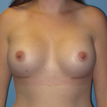 Breast Augmentation After Patient 1