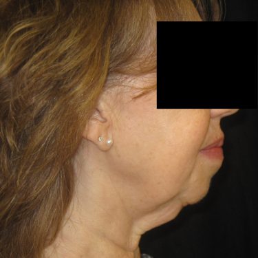 Facelift Before Patient 5
