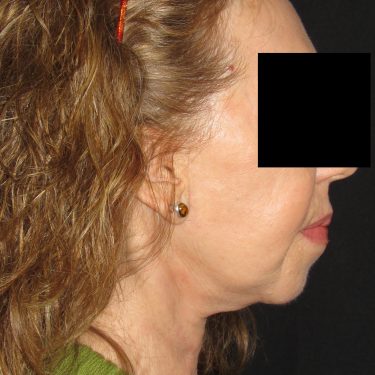 Facelift After Patient 5