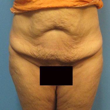 Tummy Tuck Before Patient 19