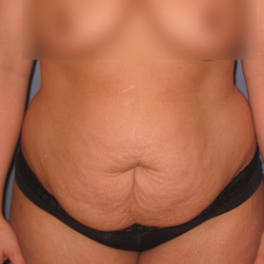 Tummy Tuck Before Patient 17