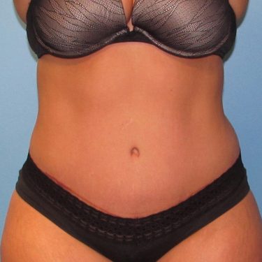 Tummy Tuck After Patient 17