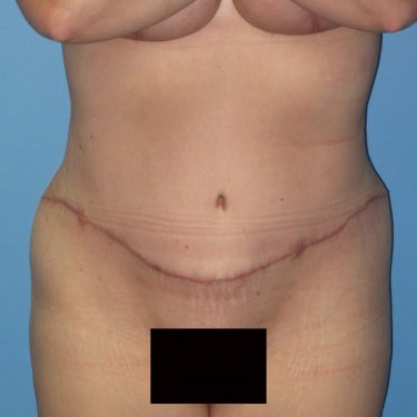 Tummy Tuck After Patient 25