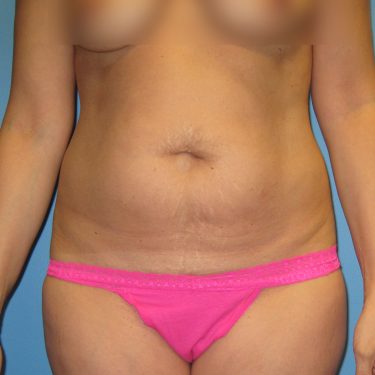 Tummy Tuck Before Patient 16