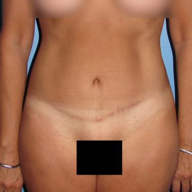 Tummy Tuck After Patient 16