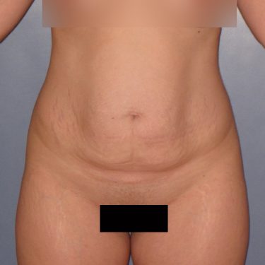 Tummy Tuck Before Patient 15