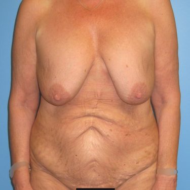 Tummy Tuck Before Patient 14