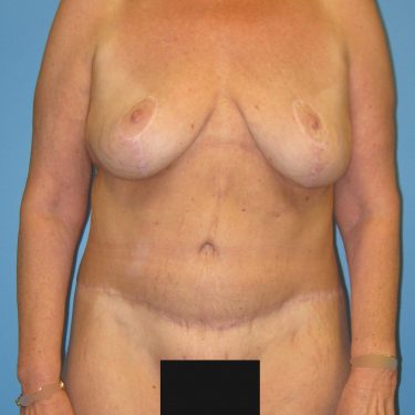Tummy Tuck After Patient 14