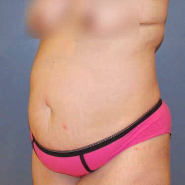 Tummy Tuck Before Patient 11