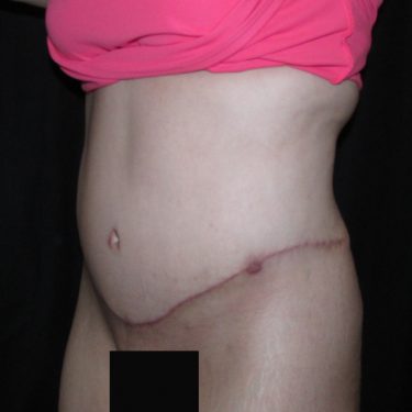 Tummy Tuck After Patient 11