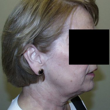Facelift Before Patient 4