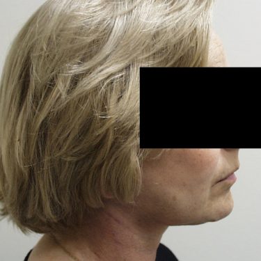Facelift After Patient 4