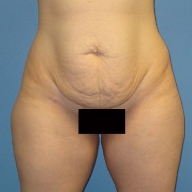 Tummy Tuck Before Patient 9