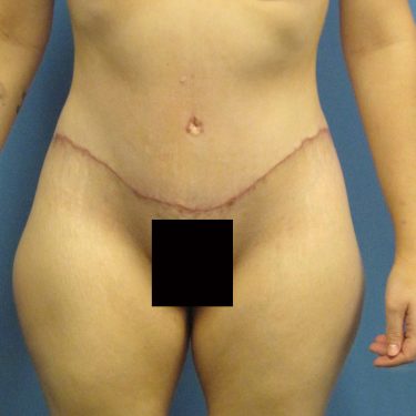 Tummy Tuck After Patient 9