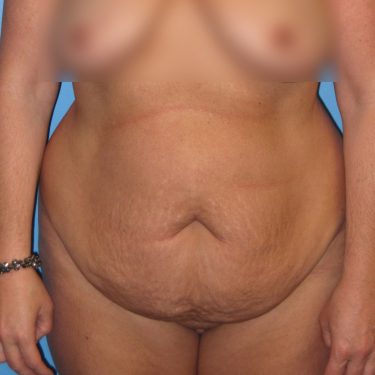 Tummy Tuck Before Patient 8